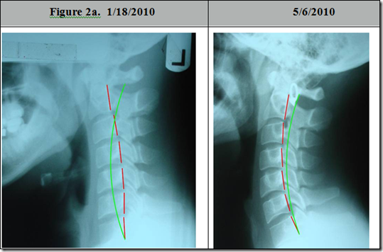 American Journal of Clinical Chiropractic - Chiropractic BioPhysics ...